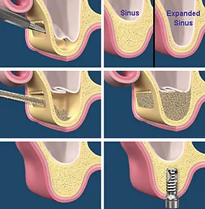 Sinus Augmentation